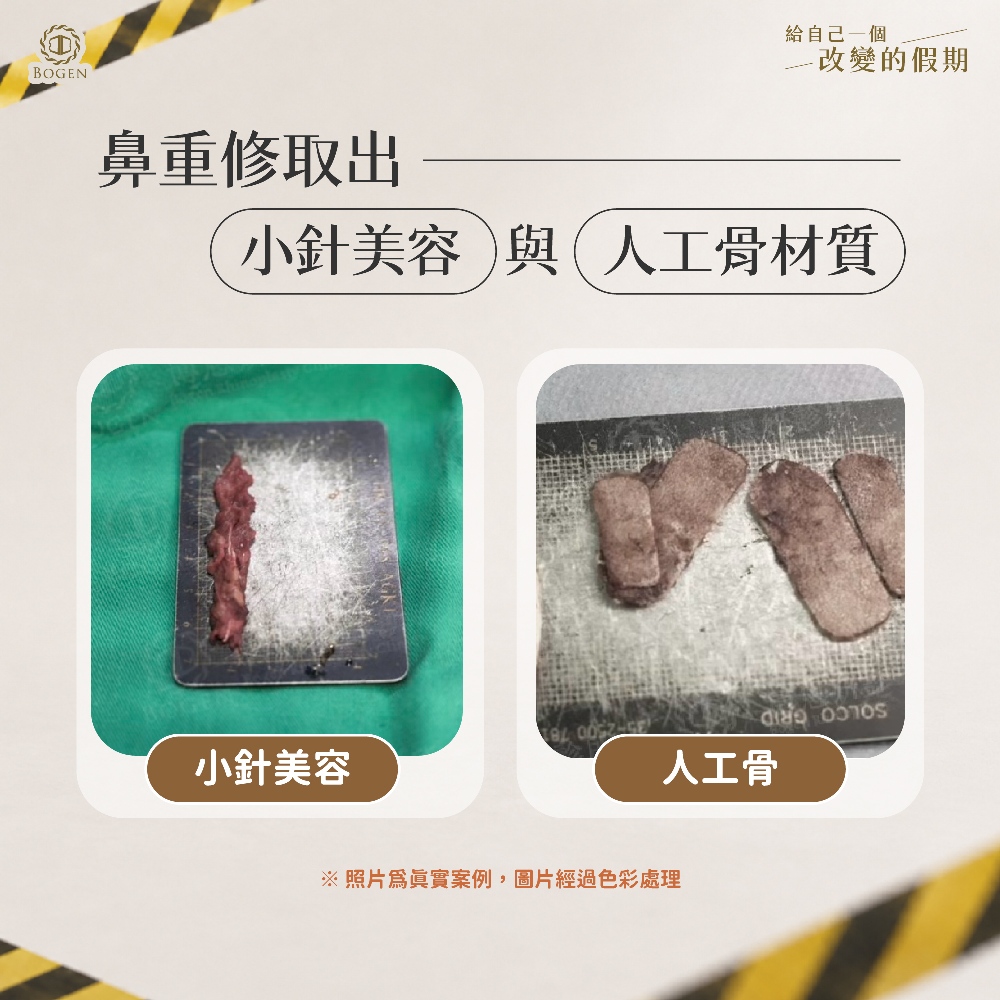 鼻重修取出小針美容與人工骨材質,博恩妍